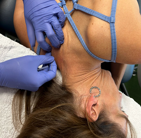 showing dry needling technique